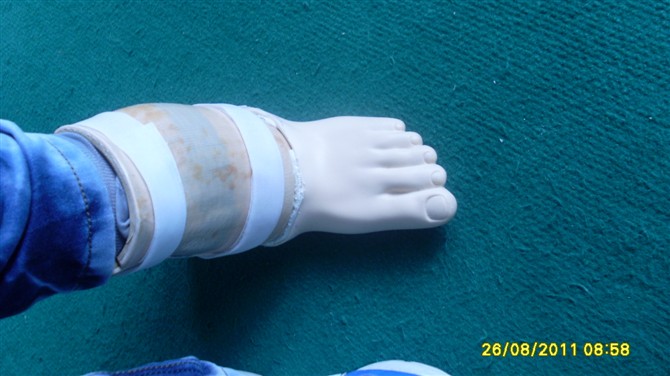 半足假肢 (2)(圖1)